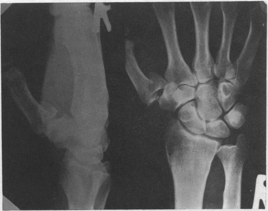 84 Fig. 10. Bennett's fracture dislocation of thumb metacarpal. replaced; damage to actively growing epiphyses can Fig. 11. Old untreated Bennett's fracture.