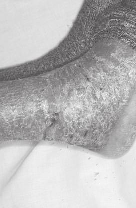 Infliximab for intractable PsA A B C Figure 1 Skin manifestations on admission. A Multiple erythematous plaques and pustules on the trunk. B Erythematous plaques with silver scales on the right ankle.