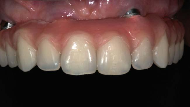 The definitive impression was made at implant or abutment level 4 months after implant placement, according to a previously reported protocol.