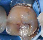 If diagnosis is delayed inappropriately, more extensive loss of tooth structure, with the accompanying increased risk of insult to the pulp, may then create a requirement for more advanced treatment,