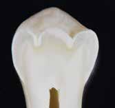 ) Summary Evidence has accumulated showing that occlusal caries is frequently underdiagnosed and consequently progresses unimpeded toward the pulp, and that the use of an explorer to detect caries is