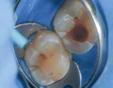 Caries Res. 1993;27(5):409-416. 5. Penning C, van Amerongen JP, Seef RE, ten Cate JM. Validity of probing for fissure caries diagnosis. Caries Res. 1992;26(6):445-449. 6. McComb D, Tam LE.