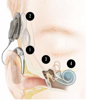 More about hearing aids 1. Microphones on the sound processor pick up sounds and the processor converts them into digital information. 2.