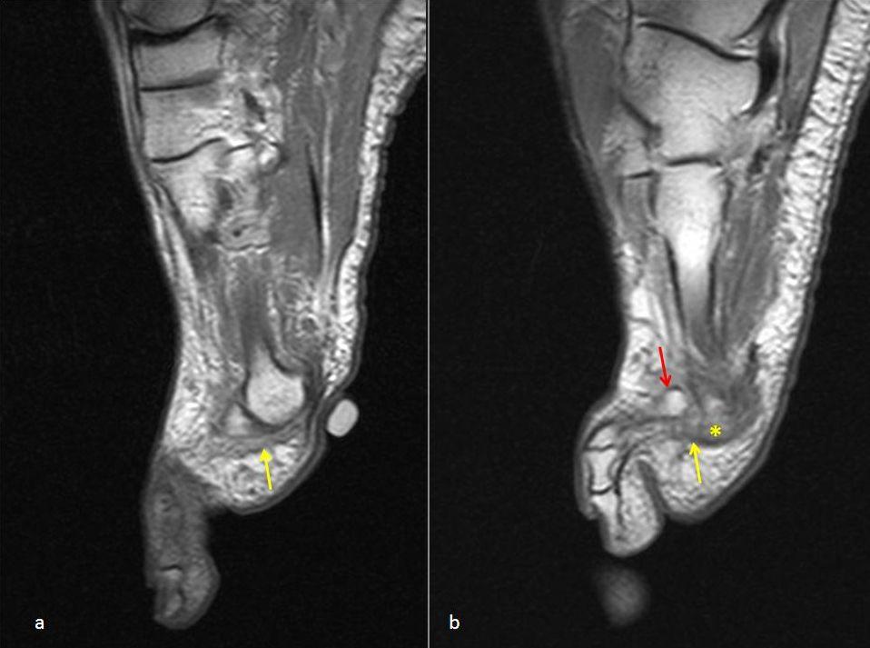 LIGAMENT ABNORMALITIES Figure 03: PLANTAR PLATE DISRUPTION. Male 40-year-old.