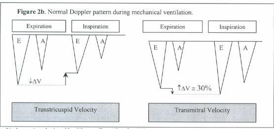 Variations on a Theme Ventilators Normal IPPV * will produce opposite respirophasic changes in velocity Hypovolemia increased these changes further Tamponade MV opposite direction and attenuated