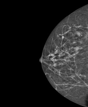 CASE 4 Case solving: Negative The SenoBright technique Screening mammogram