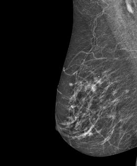cysts. (Standard mammogram images).