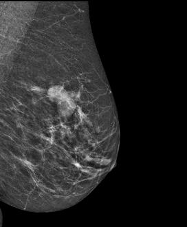 Performed after an inconclusive mammogram and ultrasound, the SenoBright exam