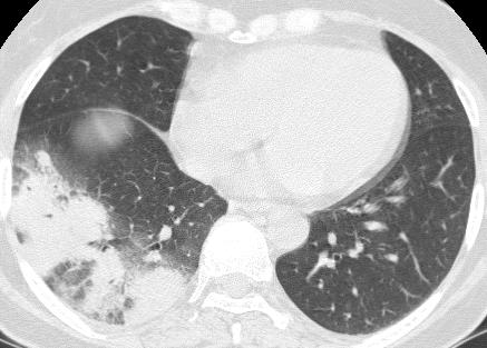 Axial chest CT obtained 1 day after