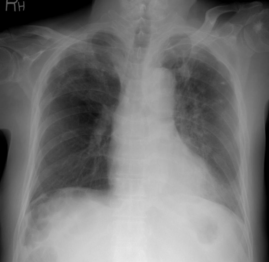 Grave outcome CASE 2 M/79 Cough, Sputum CKD, DM, HTN, CVA Figure 5-1.