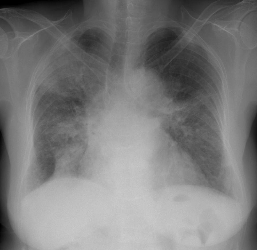 Grave outcome CASE 3 F/70 Dyspnea COPD, HTN Figure 6-1.