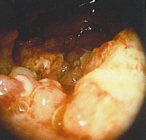 Endometrial biopsy (persistent IMB >45 with treatment failure to