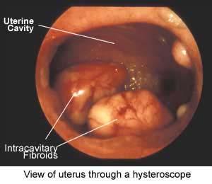 uterine