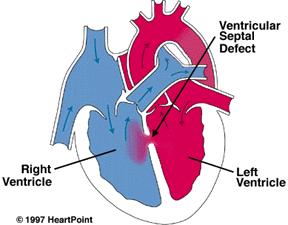 Ventricular Septal Defect l VSD is an abnormal opening in the ventricular septum,