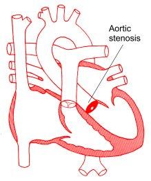 Aortic Stenosis Hemodynamics l Pressure hypertrophy of the LV and LA with obstruction to flow