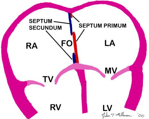 Atrial Septal Defect l ASD is an opening in the atrial septum