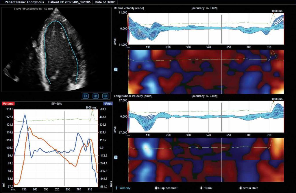 Elastography Elastography is ultrasound imaging technology that reveals relative elasticity of tissues against external