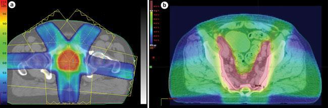 Radiotherapy A key component of cancer therapy approximately 14 million new cancer cases per year