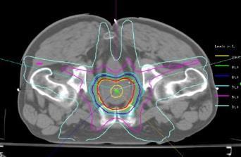 Radiotherapy: the complete dose specification Proton Radiotherapy TPS calculations