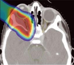 phantoms Phantom & dosimeter development Radiotherapy Imaging & IGRT Measurement of doses