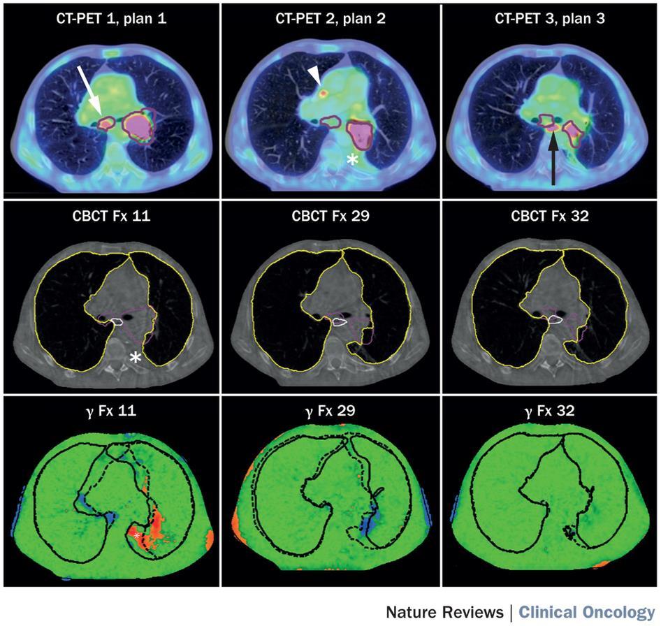 Adaptive radiotherapy planning using serial FDG-PET CT imaging in a patient with stage