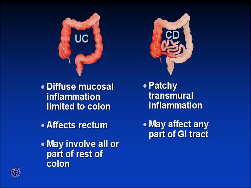 IBD Overview Approximately 1.
