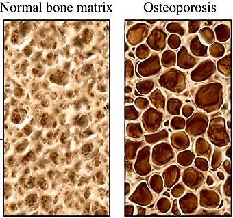 For example increase osteocyte activity will causes osteoporosis or increase activity of osteocyte followed by