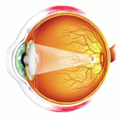 If the lens is cloudy from a cataract, the image striking the