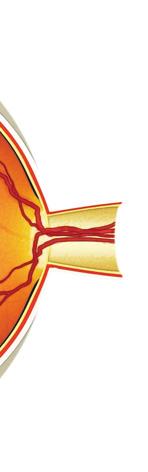 Cataract surgery should be performed when the visual loss from