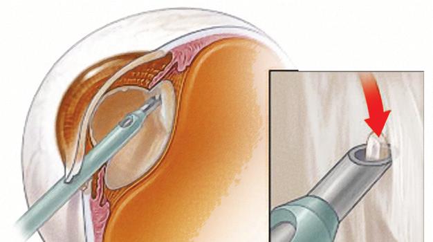 Extracapsular extraction This procedure requires a larger incision to remove the cloudy lens.