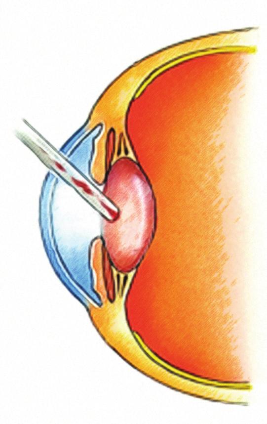 be able to see after cataract surgery.