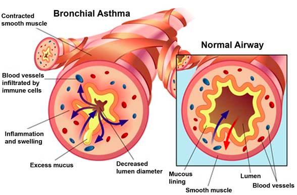 Asthma: