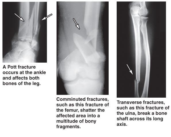 Fractures Figure 6 18
