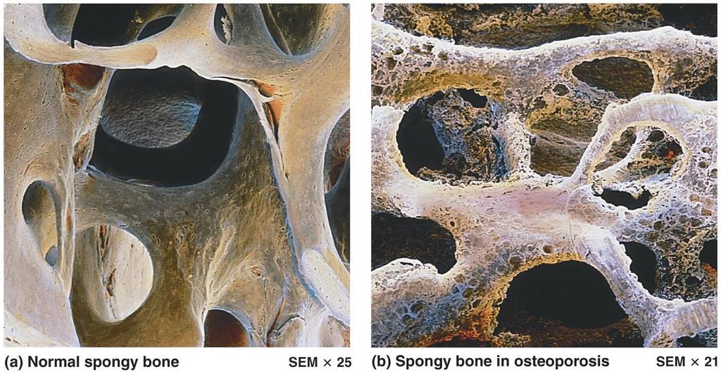 Osteopenia Figure 6 19 The