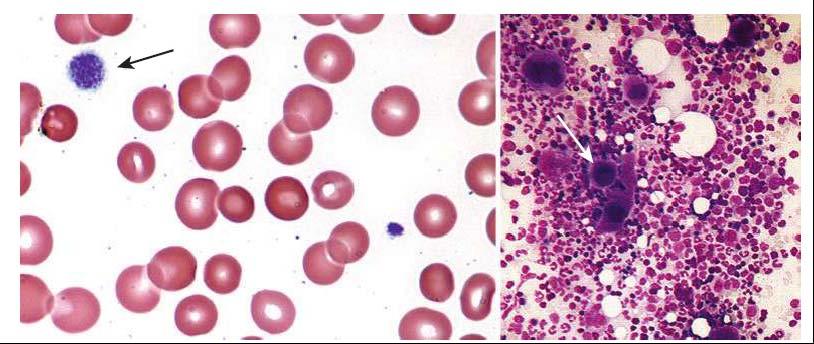 Blood smear and bone marrow aspirate from a child who had ITP showing large platelets (blood smear