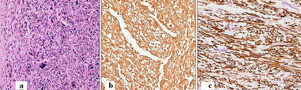 A-770 IHC in Soft Tissue Tumors HISTOLOGICAL TYPE FREQUENCY PERCENTAGE Fibrosarcoma 14 14.4% Leiomyosarcoma 13 13.4% Rhabdomyosarcoma 5 5.2% MPNST 4 4.2% Ewing s/pnet 5 5.