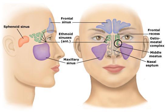 1 Acute Chronic is the inflammation of the inner lining of the parnasal sinuses due to infection or non-infectious causes such as allergies or environmental pullutants.
