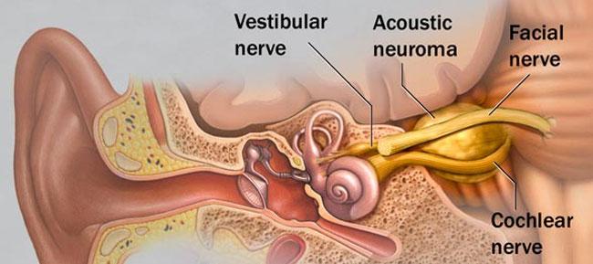 Vestibular Schwannoma Incidence 13-20 cases per million Sporadic Asymmetrical hearing loss Tinnitus