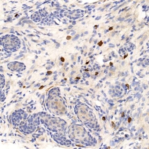 Niraparib Mediated Increase in Tumor Infiltrating CD8