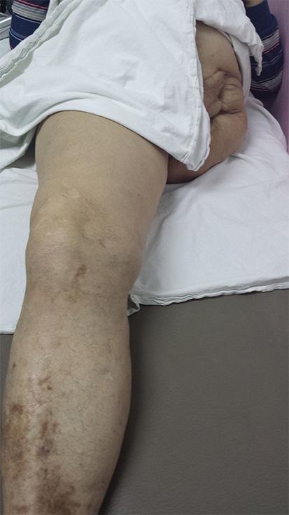 Prilikom pipanja mesta amputacije pacijent navodi da oseća dodir kao bol i pritisak u predelu pete i prstiju levog stopala. Žali se i na bolove na mestu reza (slika 5. i 6.