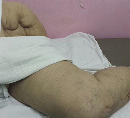 Pacijent je prilikom ranjavanja imao 55 godina i negira bilo kakve bolove u levoj nozi pre toga.