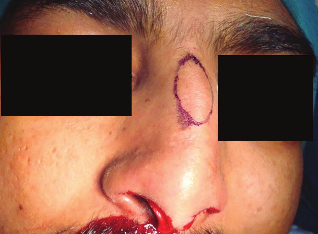 On examination of the nose, it was found that the external nose was bulky to the patient s face, there was gross deviation of the nasal framework to the left, with a bony cartilaginous hump over the