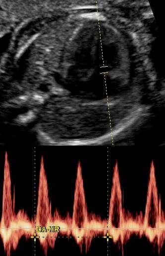 Sinus tachycardia 1:1 AV conduction 1. Anaemia 2.