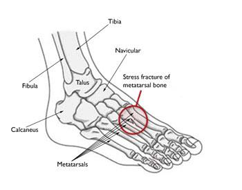 The most common sites for stress fractures in the foot are the metatarsal bones. Many stress fractures are overuse injuries.