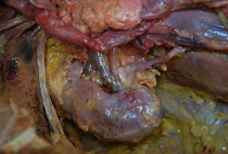 Gross Renal Anatomy Kidneys covered by capsule Fibrous