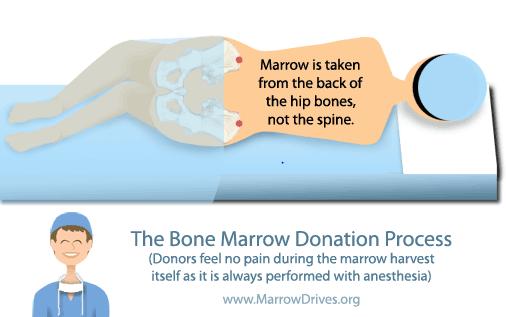 Stem Cell Collection Bone Marrow Harvest HPCs harvested from the posterior iliac crests via multiple large-bore needle aspirations Collection procedure: Scheduled in the OR Multiple