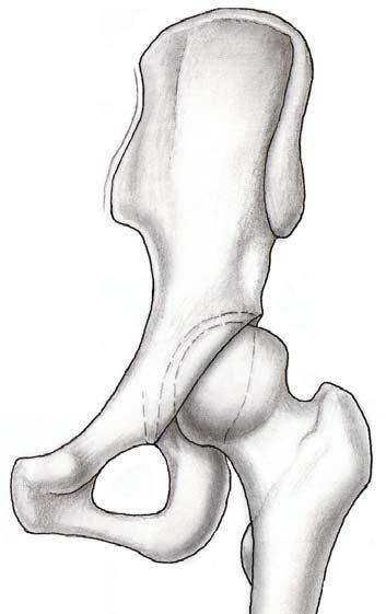 Osteotomies of the pelvis > Shelf