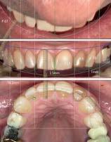 190 Fig 9 Finished 2D digitl smile design. () 12 o clock view (top), frontl view (middle), occlusl view (ottom).