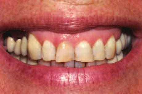 Clinical Figure 2: View of a patient with excessive wear and over-eruption of her incisors. Figure 3: Orthodontics has intruded the incisors to create space to bond them to a pleasing length.
