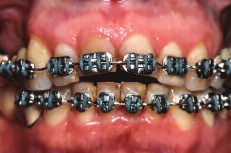 Figure 5: The brackets were then replaced and the orthodontics completed, putting the teeth and tissue in an ideal aesthetic and functional position.